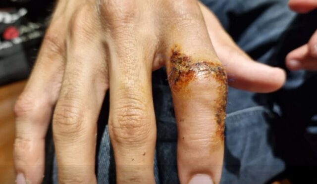 Toprak Razgatlıoğlu’nun sakat parmağı ortaya çıktı